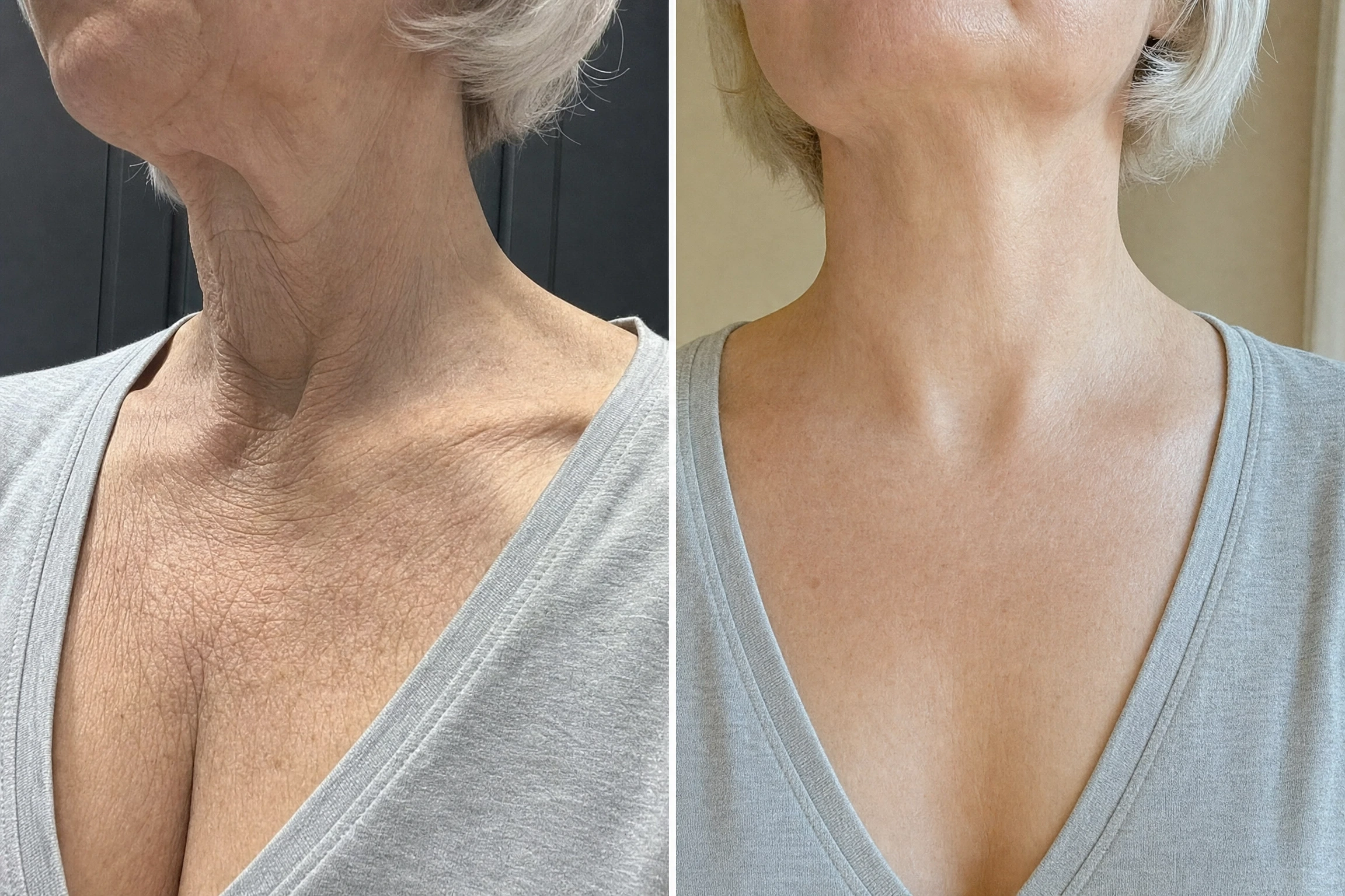 לפני ואחרי השימוש ב־Olavita Tri-Lift