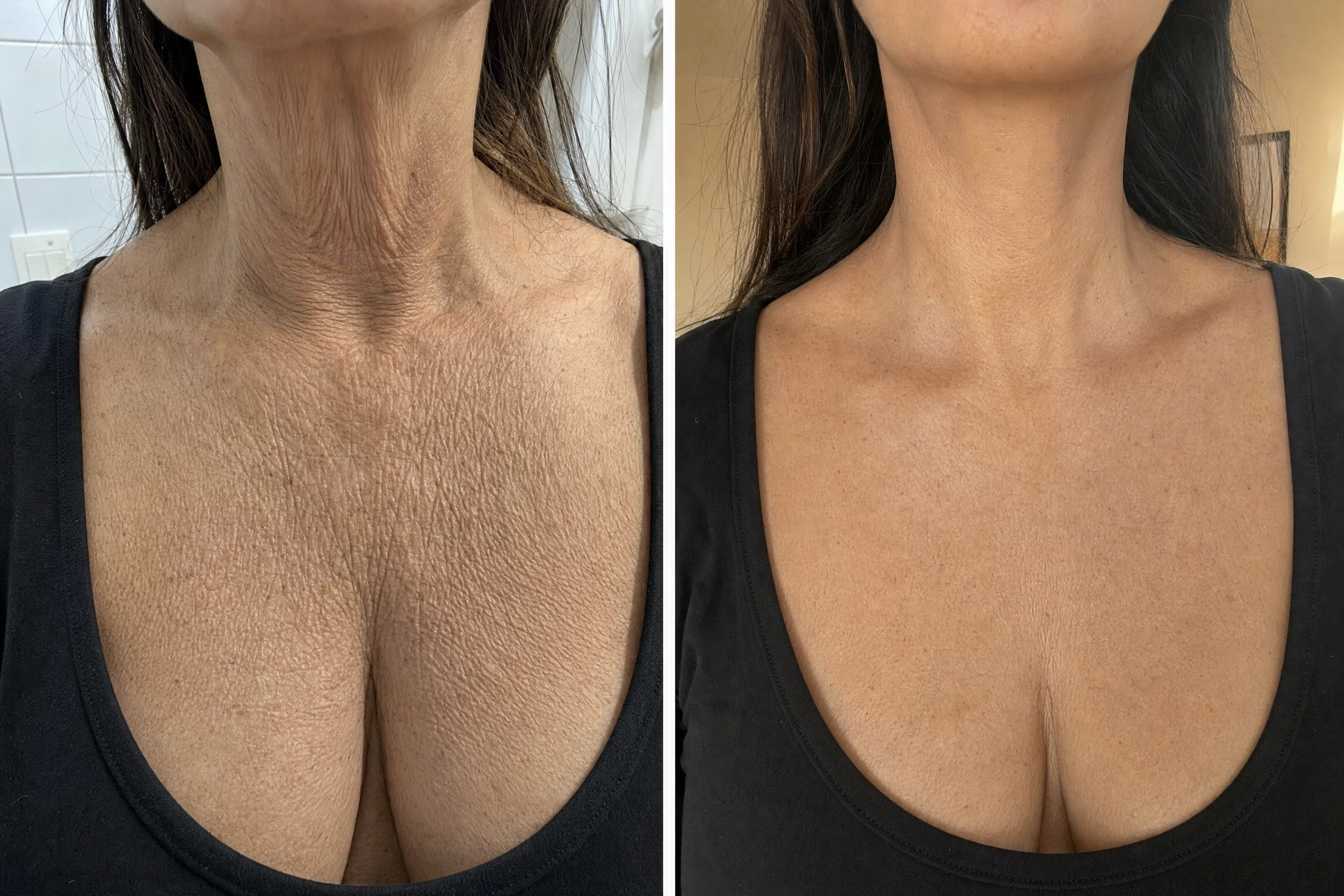 לפני ואחרי השימוש ב־Olavita Tri-Lift