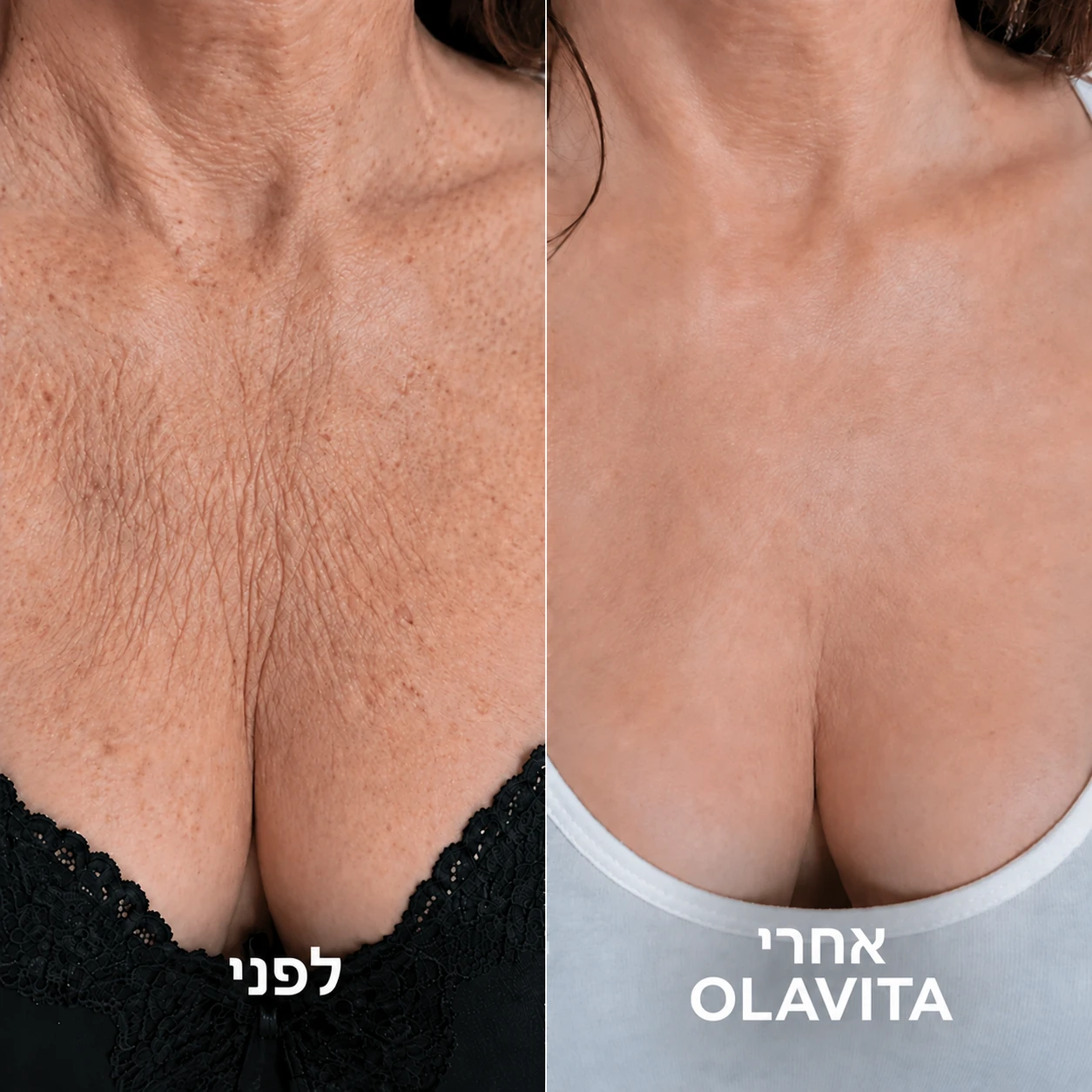 אזור מחשוף מקומט לפני ואחרי Olavita